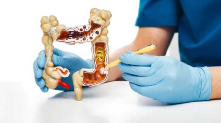 Unde doare colonul? Unde doare colonul